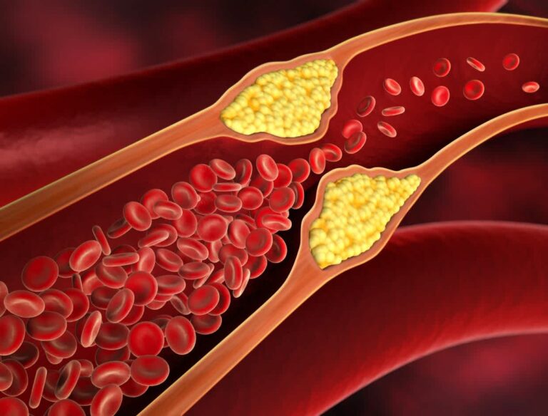 High Cholesterol Specialist Delray Beach